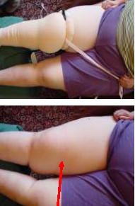 【一般骨科和创伤】止血带和肥胖患者白皮书