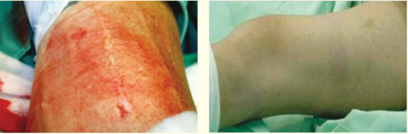 【生理学和生物学】Surgical Tourniquets in Orthopaedics