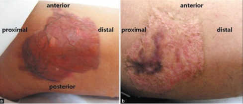 【气囊止血带副作用】止血带造成的化学烧伤