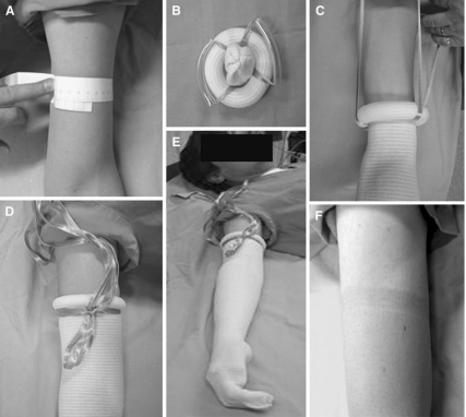 【生理学和生物学】硅胶环VS气囊止血带：健康受试者的定量比较研究