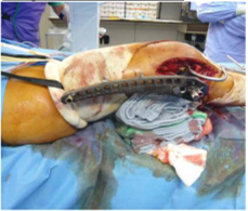 【一般骨科和创伤】在单侧左膝股骨远端创伤中使用HemaClear的一例报道