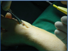 【生理和技术说明】腿部的不完全驱血可能导致患者在全膝关节置换后的认知障碍