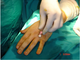 【上肢】Forearm Sterile Elastic-A Preferred Method For Carpal Tunnel Release(CTR)
